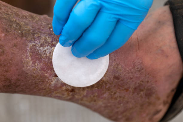 Cara Menghilangkan Bekas Luka Korengan Secara Alami